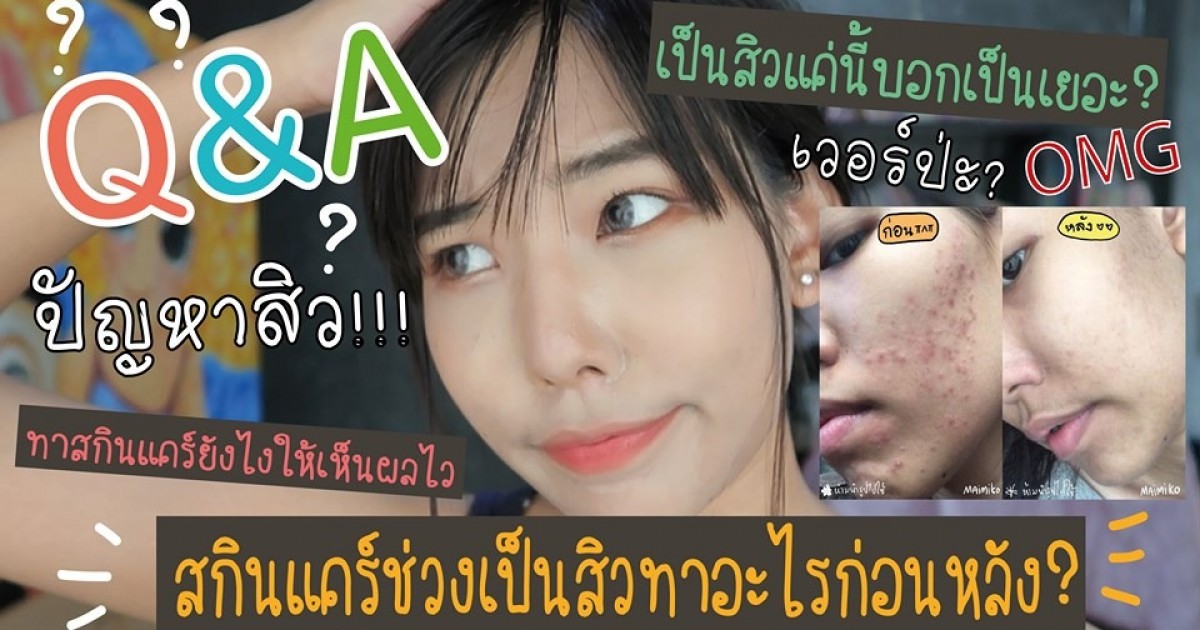 Q&A ปัญหาสิวยอดฮิต สเต็ปการทาสกินแคร์ช่วงเป็นสิวทาอะไรก่อนหลัง?